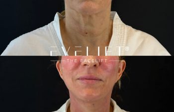 female patient before and after EVELIFT®