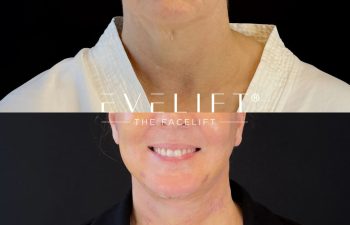 female patient before and after EVELIFT®