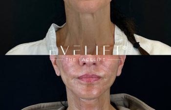 female patient before and after EVELIFT®