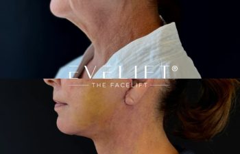 female patient before and after EVELIFT®