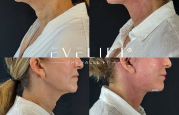 female patient before and after EVELIFT®
