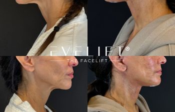 female patient before and after EVELIFT®