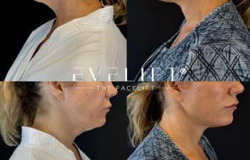 female patient before and after EVELIFT®