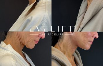 female patient before and after EVELIFT®