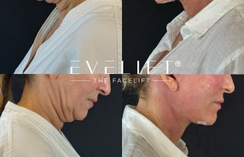 female patient before and after EVELIFT®