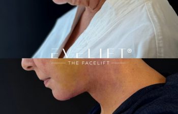 female patient before and after EVELIFT®