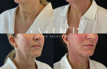female patient before and after EVELIFT®