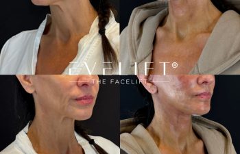 female patient before and after EVELIFT®