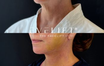 female patient before and after EVELIFT®