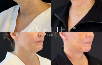 female patient before and after EVELIFT®