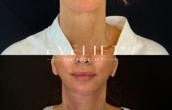 female patient before and after EVELIFT®