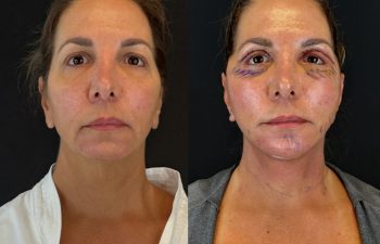 female patient before and after EVELIFT®