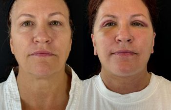 female patient before and after EVELIFT®