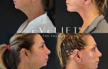 female patient before and after EVELIFT®