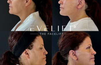 female patient before and after EVELIFT®