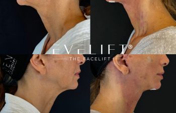 female patient before and after EVELIFT®