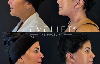 female patient before and after EVELIFT®