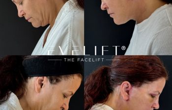 female patient before and after EVELIFT®
