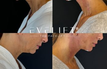 female patient before and after EVELIFT®