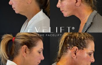 female patient before and after EVELIFT®