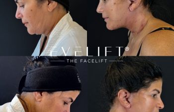 female patient before and after EVELIFT®