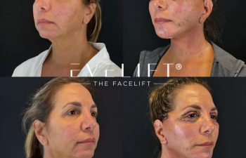 female patient before and after EVELIFT®