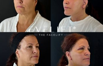 female patient before and after EVELIFT®