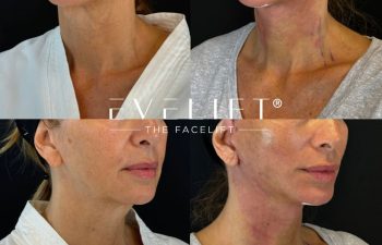 female patient before and after EVELIFT®