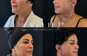 female patient before and after EVELIFT®
