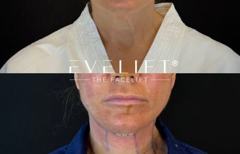 female patient before and after EVELIFT®