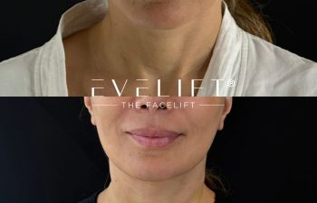 female patient before and after EVELIFT®