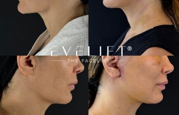 female patient before and after EVELIFT®