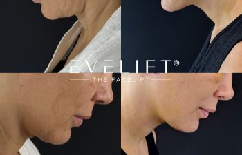 female patient before and after EVELIFT®