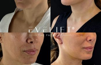 female patient before and after EVELIFT®