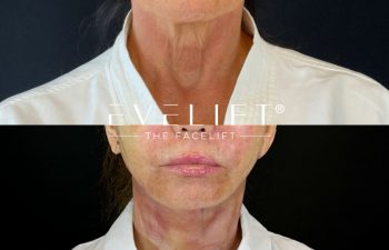 female patient before and after EVELIFT®