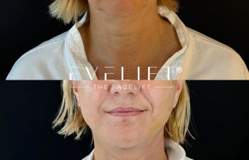female patient before and after EVELIFT®