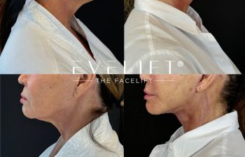 female patient before and after EVELIFT®