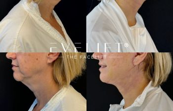 female patient before and after EVELIFT®