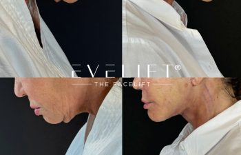 female patient before and after EVELIFT®