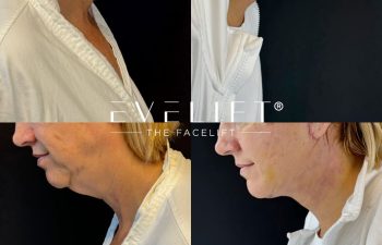 female patient before and after EVELIFT®