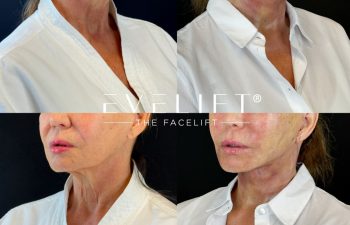 female patient before and after EVELIFT®