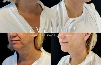 female patient before and after EVELIFT®