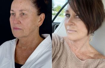 female patient before and after EVELIFT®