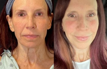 female patient before and after EVELIFT®