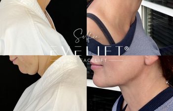female patient before and after EVELIFT®