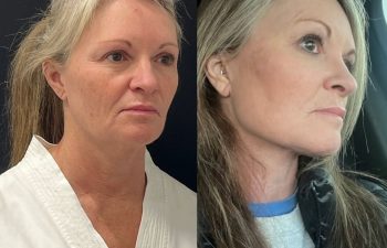 female patient before and after EVELIFT®
