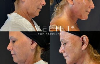 female patient before and after EVELIFT®