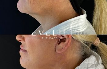 female patient before and after EVELIFT®