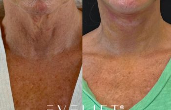female patient before and after EVELIFT®