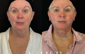 female patient before and after EVELIFT®